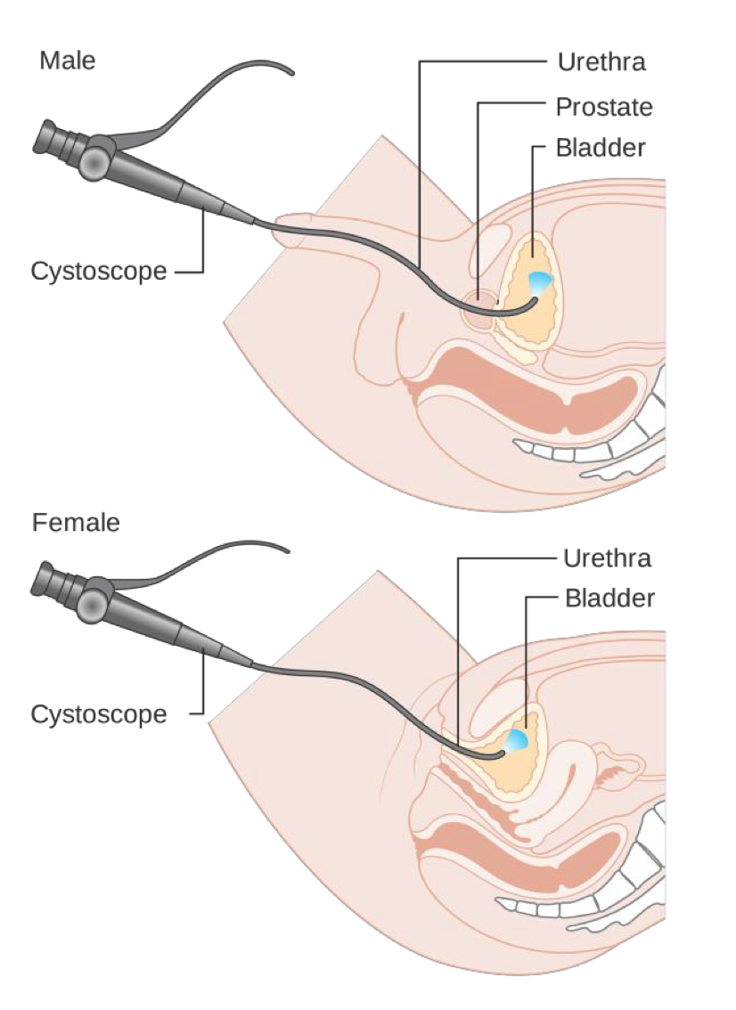 Cystoscopy in male and female patients